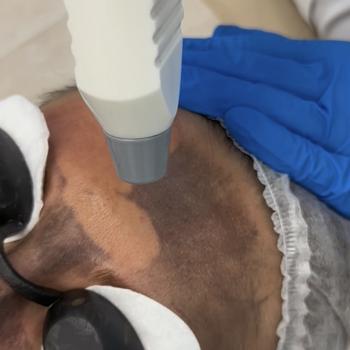 Лазерный карбоновый пилинг