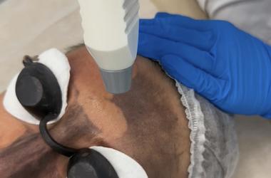 Лазерный карбоновый пилинг