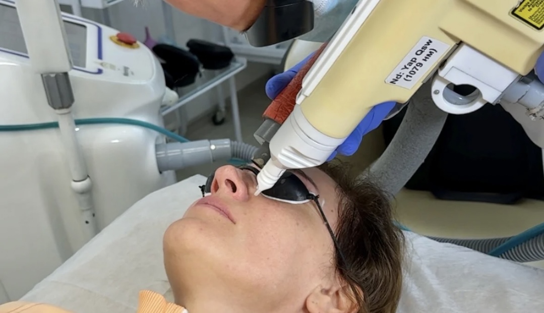 Лазерное удаление сосудов