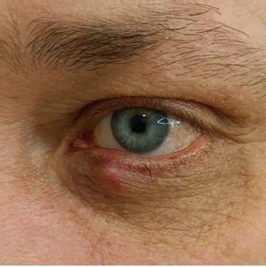 Лечение халязиона лазером 