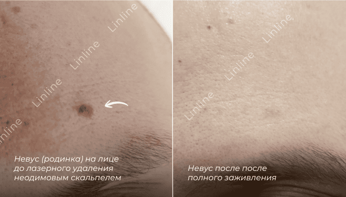 Невус на лбу до и после. До – пигментное пятно. После – ровный тон, рубец отсутствует. Результат удаления родинки в Линлайн.