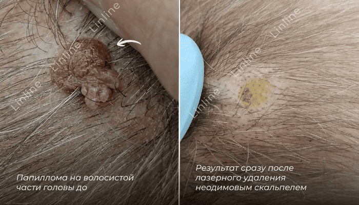 Бородавка на голове до и после. До – выступающее образование среди волос. После – кожа очищена, рост волос сохранён. Удаление бородавки в Линлайн