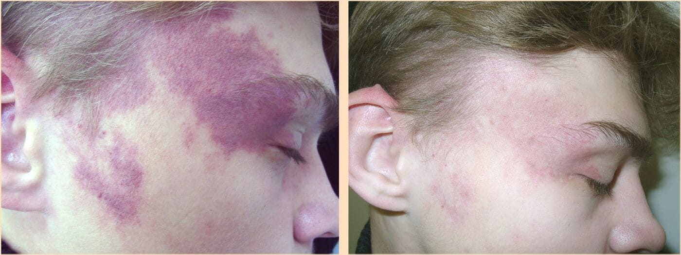 Лазерное удаление гемангиом