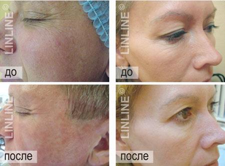 Фракционное неодимовое омоложение до/после