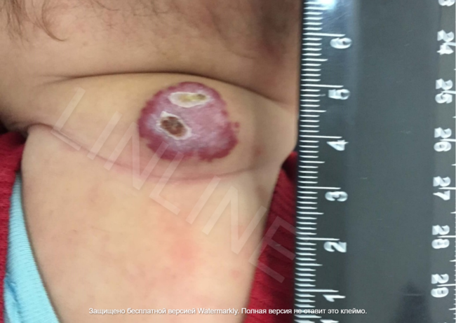 Состояние гемангиомы на шее у ребенка через 14 дней после первого сеанса, непосредственно перед второй лазерной процедурой. Подготовка к следующему этапу лечения в LINLINE.