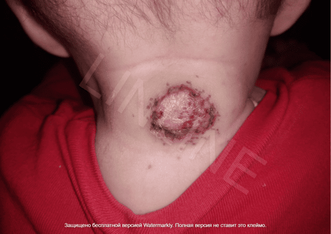 Гемангиома на шее у ребенка через 2 дня после второго сеанса лазерного лечения в LINLINE. Продолжение регресса образования, врач Буравский А.В.