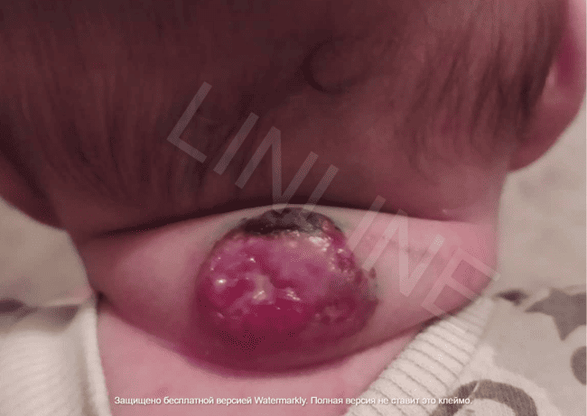 Гемангиома на шее у ребенка через 4 дня после первого сеанса лазерного лечения. Врач Буравский А.В., клиника LINLINE Минск. Уменьшение воспаления.