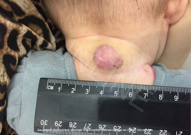 Результат лазерного лечения гемангиомы на шее у ребенка. Фото через 6 недель после первого и 4 недели после второго сеанса. Клиника LINLINE Минск. Значительное улучшение.