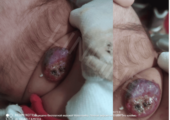 Состояние гемангиомы на шее у ребенка через 1 день после первого сеанса лазерного лечения в LINLINE. Начало положительной динамики после лазерной терапии.