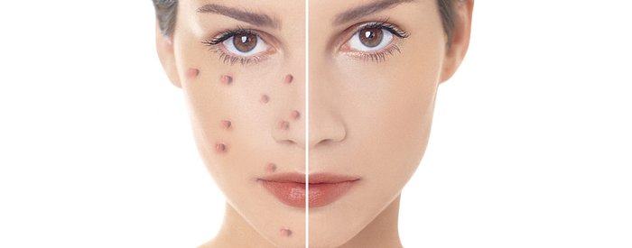 ВСЕ, ЧТО ВЫ ДОЛЖНЫ ЗНАТЬ О ЛЕЧЕНИЕ АКНЕ