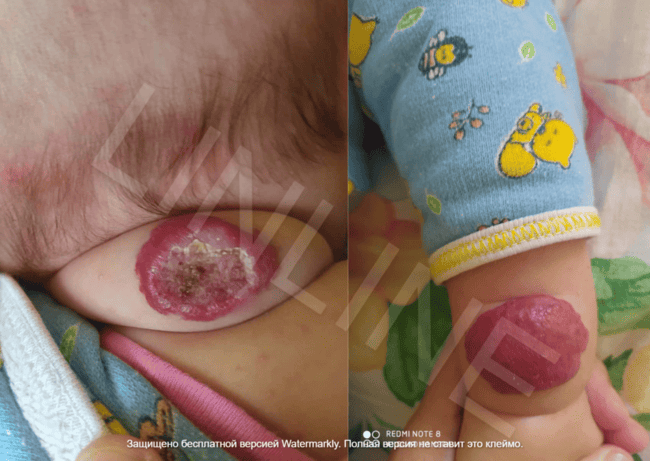 Гемангиома на шее у ребенка до лазерного лечения. Осложненная инфантильная гемангиома с некрозом и изъязвлением. Фото перед первым сеансом в LINLINE Минск.