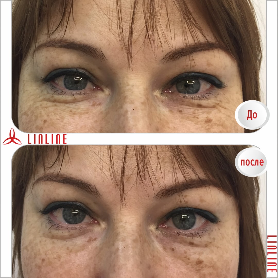 Блефаропластика до и после