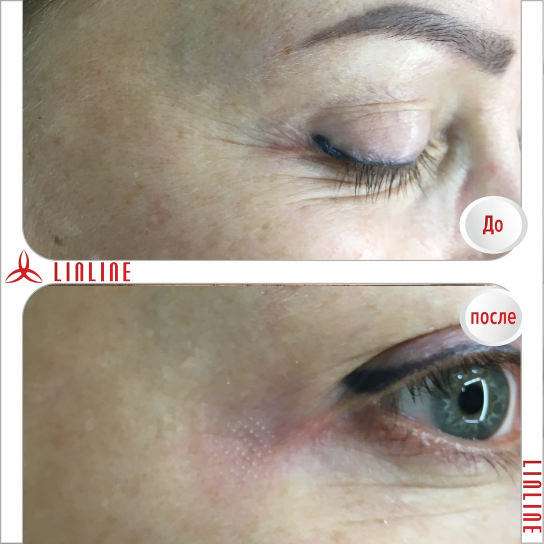 Блефаропластика лазером в Минске