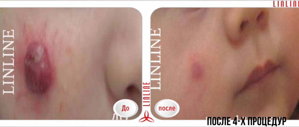 Удаление гемангиомы до/после