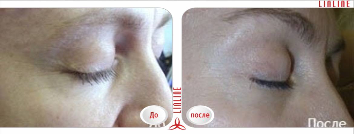 Лазерное фотоомоложение Q-switch в Минске