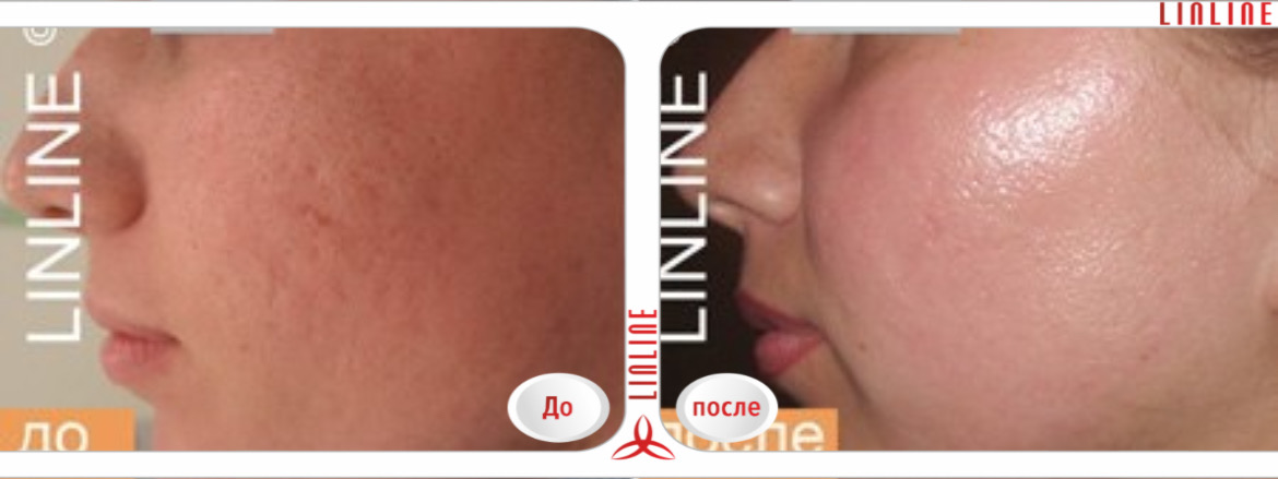 Лечение постакне, лазерная шлифовка в Минске