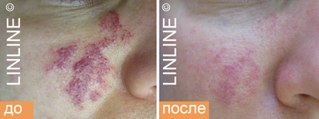 Удаление гемангиом на лице в Минске