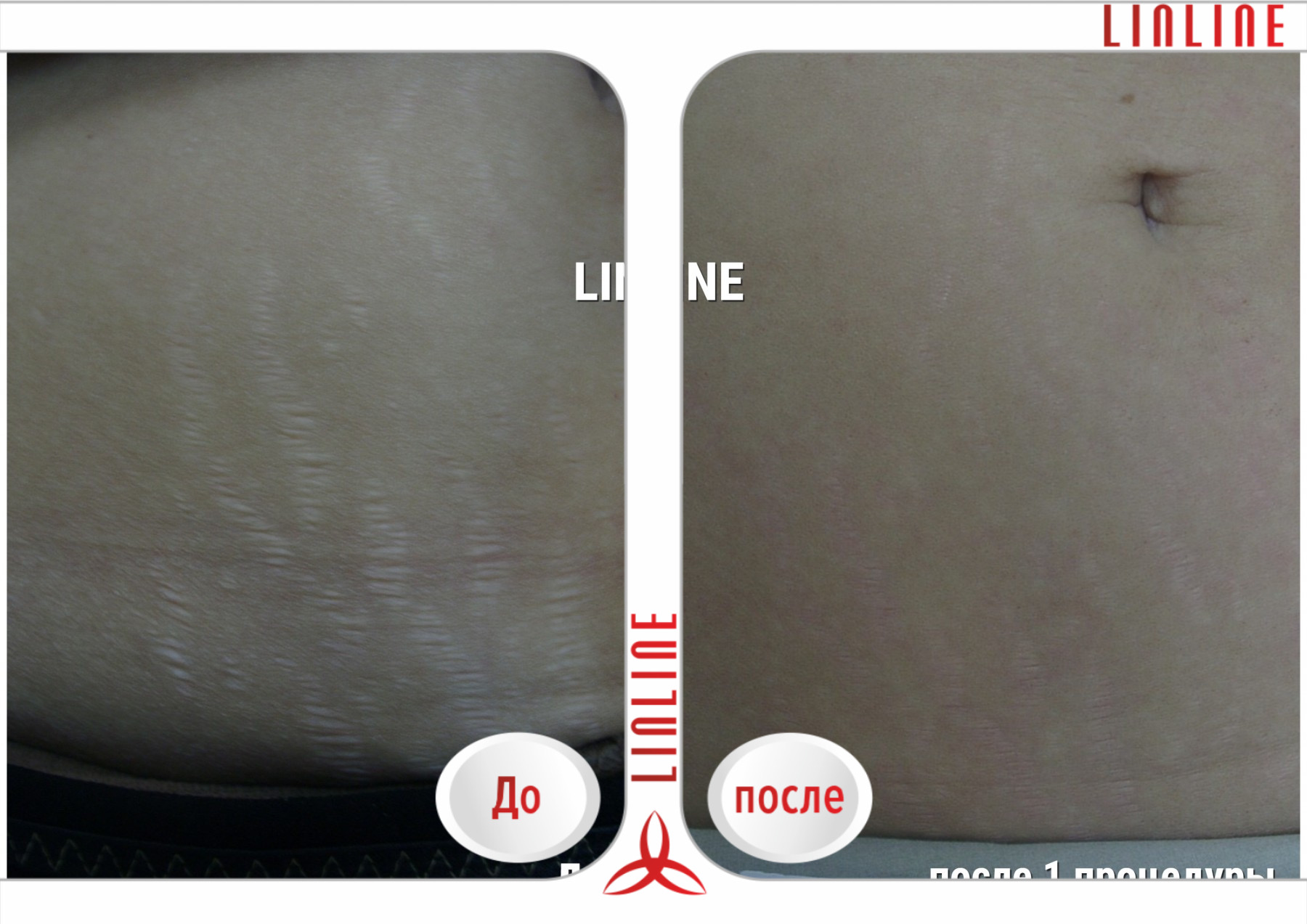 Удаление растяжек лазером в минске