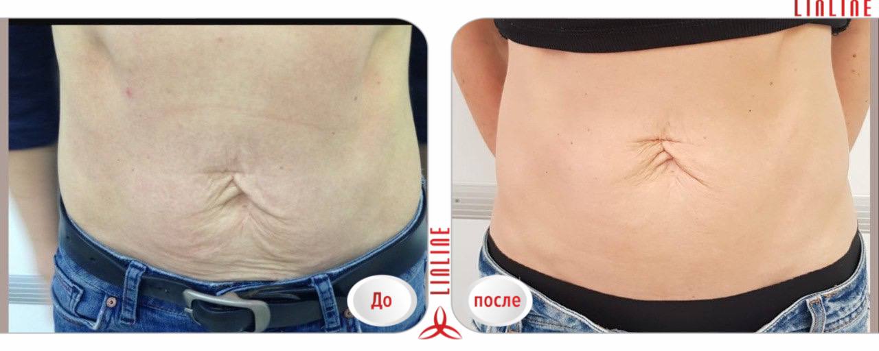 Лазерное удаление растяжек в минске Линлайн.jpg