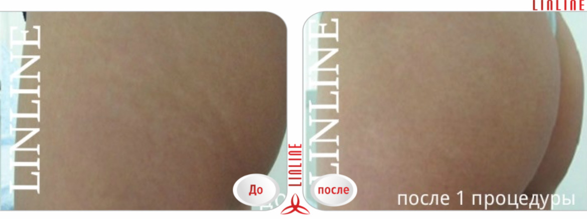 Лазерное удаление растяжек в минске