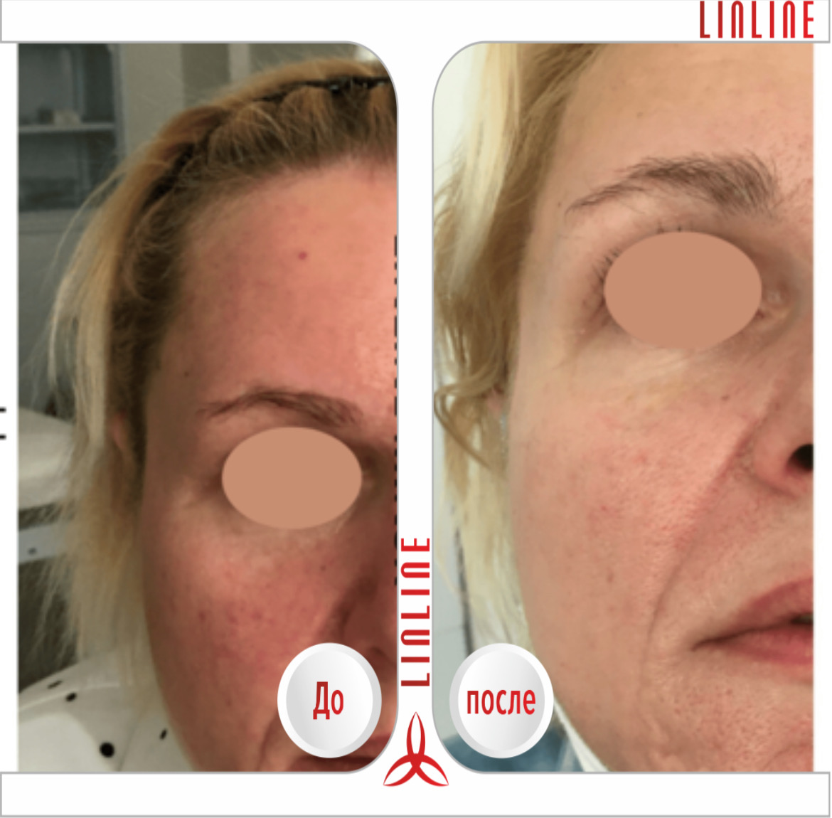 Лазерный (карбоновый) пилинг в Минске