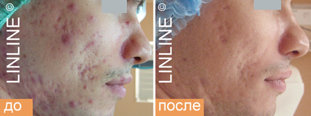 Комплексное лазерное лечение акне и постакне в Минске. Фото до и после в клинике Linline.