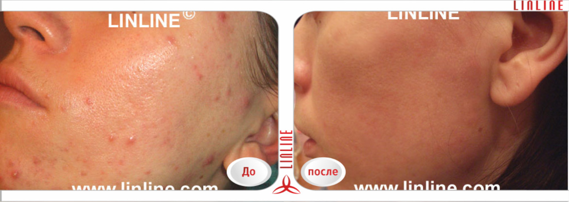 Результат лазерного лечения акне на щеках в Минске