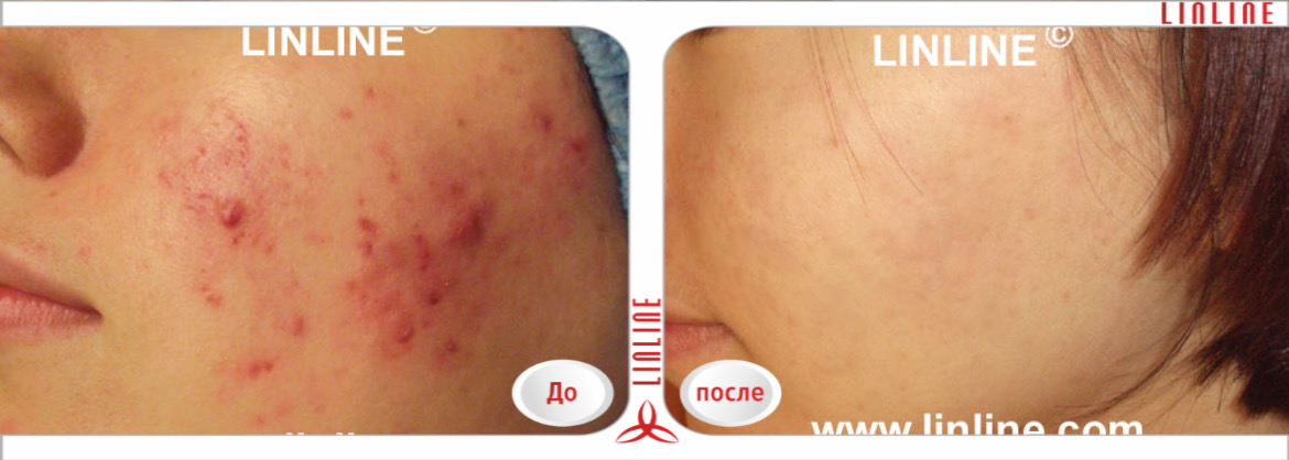 Лечение угревой сыпи на щеках — результат после курса