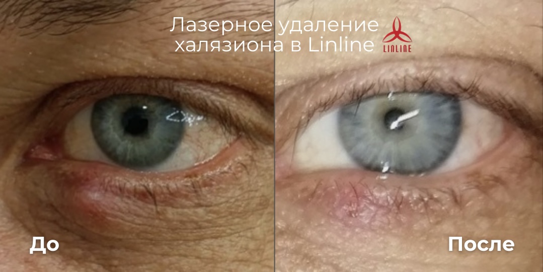 до/после удаления халязиона