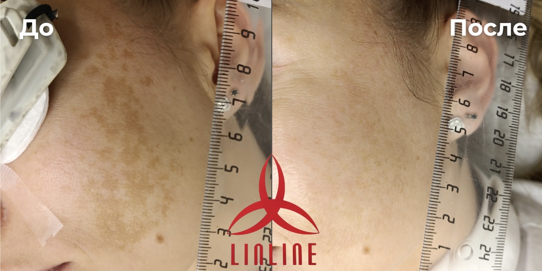 до/после удаление пигментации