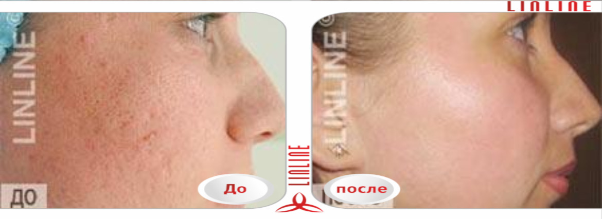 Постакне лечение лазером в Минске