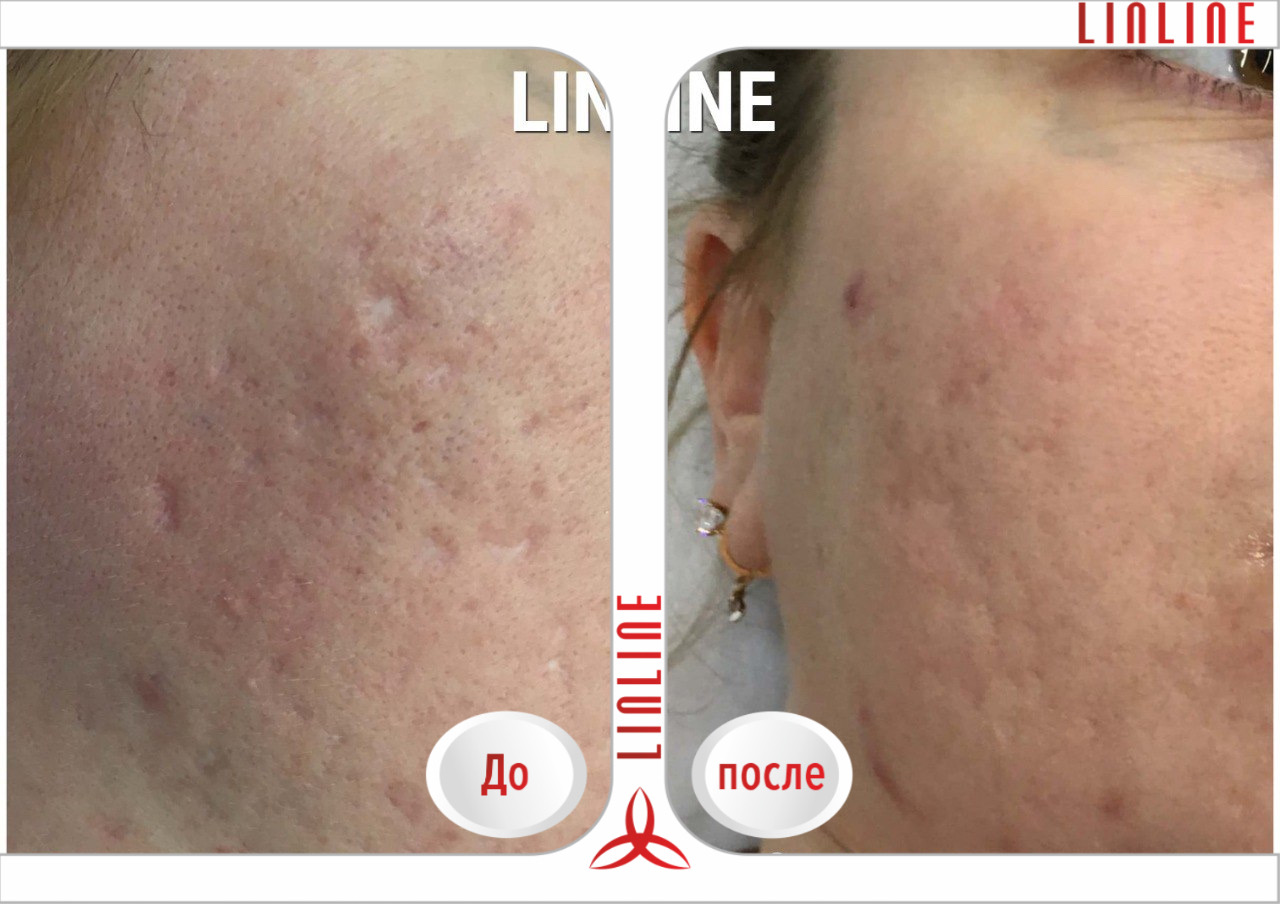 Постакне лечение лазером. до и после