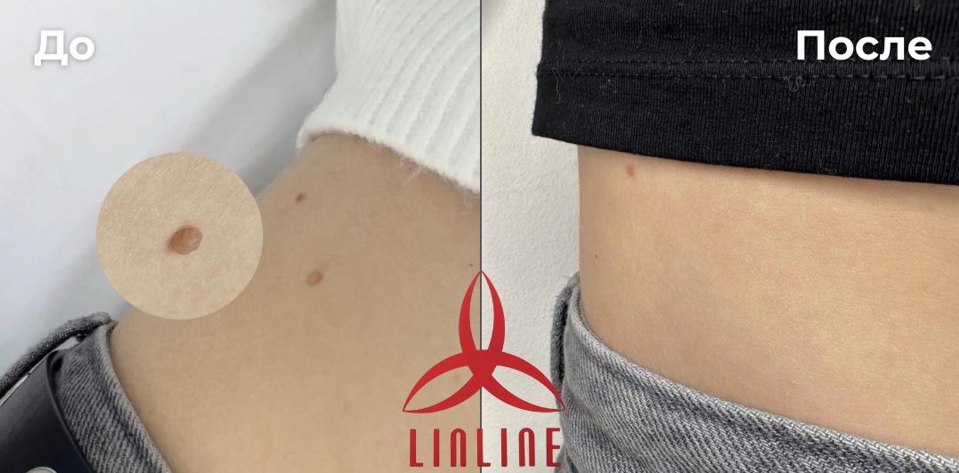 до/после удаления папиллом