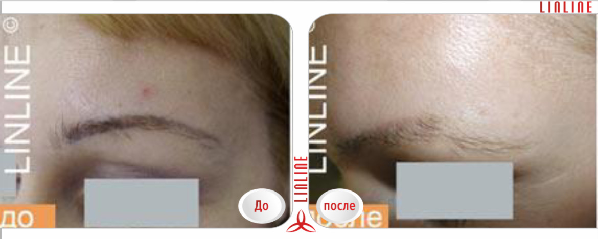 Перманентный макияж – лазерное удаление.