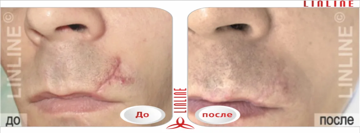 Удаление рубца до/после