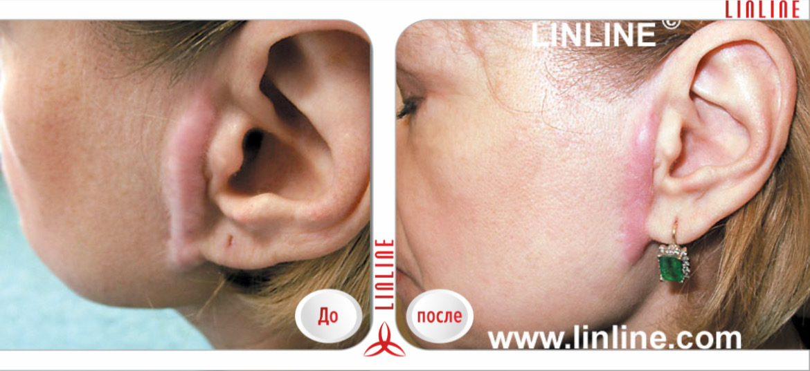 Шлифовка рубцов и шрамов лазером, стоимость