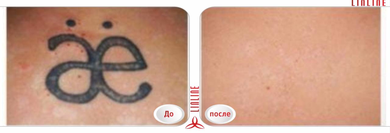 Лазерное удаление татуировки до/после