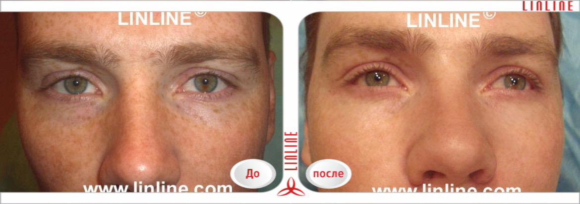 Лазерное удаление веснушек до/после