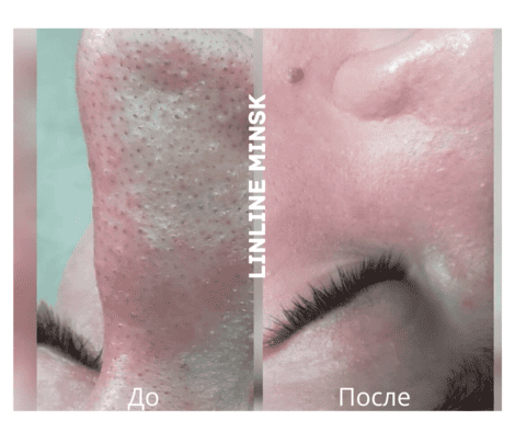 Чистка лица результат до/после 