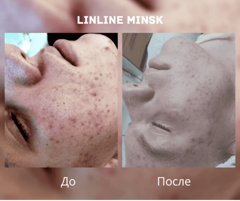 До/после чистка лица