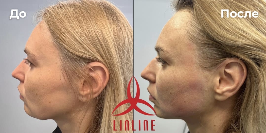 до/после СМАС-лифтинг