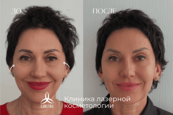 до после ботулинотерапия