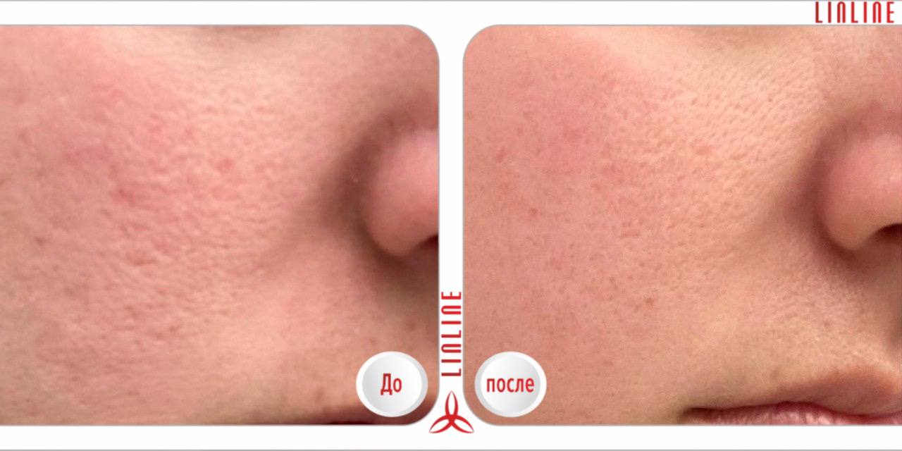 Микронидлинг в Линлайн до/после.