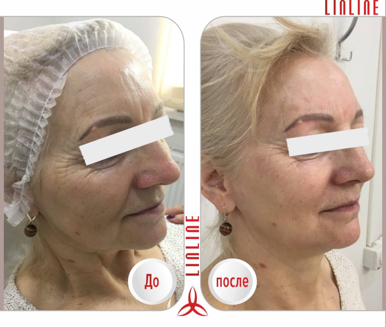 Плазмаволюмизация плюс лазерный лифтинг в Линлайн до/после