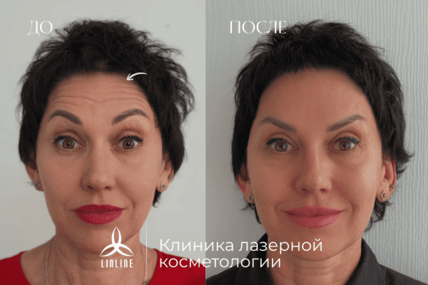 коррекция морщин до после