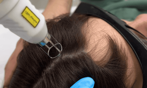 Лазерное лечение волос SkinSma