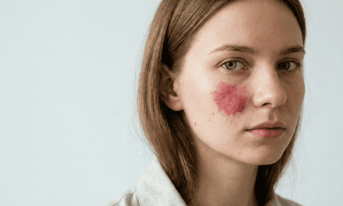 Удаление гемангиомы