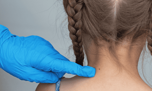 Удаление новообразований у детей лазером в Минске