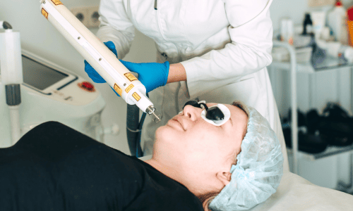 Лазерное лечение постакне