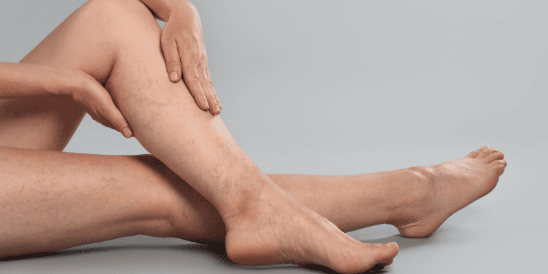 Микросклеротерапия